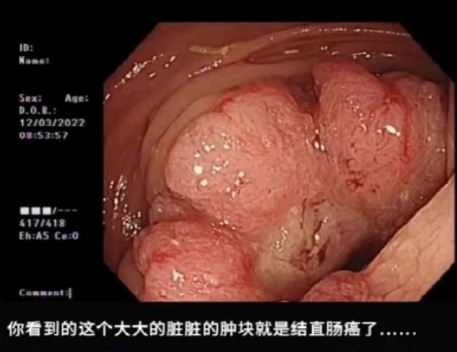 这种息肉可能会变成癌 排便出现4种异常建议及时就医 这种息肉可能会变成癌 排便出现4种异常建议及时就医