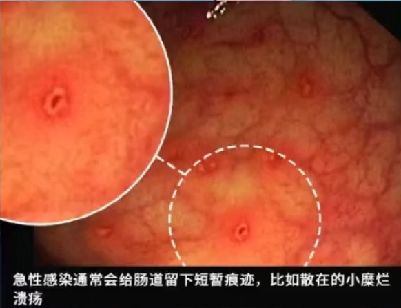 这种息肉,可能会变成癌!医生:排便出现这4种异常,建议及时就医 这种息肉,可能会变成癌!医生:排便出现这4种异常,建议及时就医