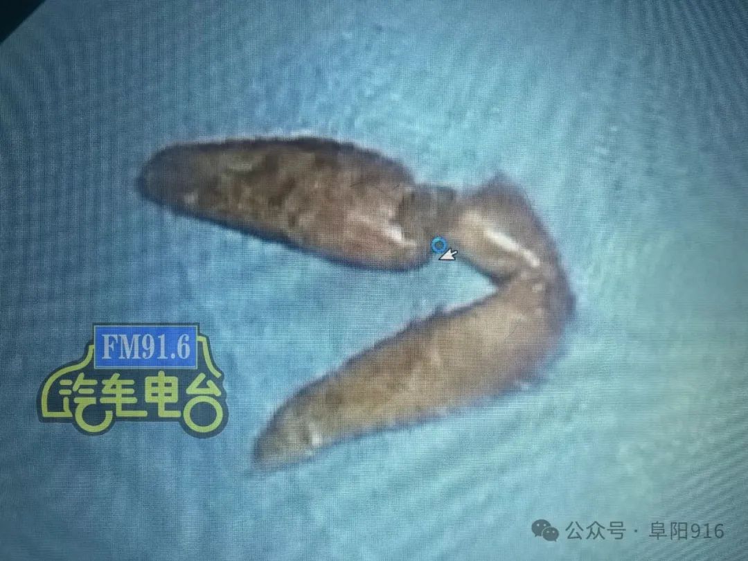 吃小龙虾后,阜城一女子紧急住院!医生提醒… 吃小龙虾后,阜城一女子紧急住院!医生提醒…