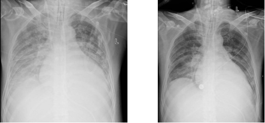 28岁小伙烧成“白肺”,去医院一查惊呆:“元凶”病毒竟然很常见 28岁小伙烧成“白肺”,去医院一查惊呆:“元凶”病毒竟然很常见
