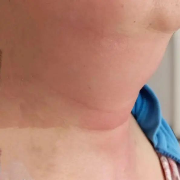 小学生脖子肿得“没了”下巴,竟是患上这个病!专家:不常见但危害大 小学生脖子肿得“没了”下巴,竟是患上这个病!专家:不常见但危害大