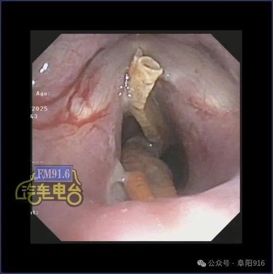 吃小龙虾后,阜城一女子紧急住院!医生提醒… 吃小龙虾后,阜城一女子紧急住院!医生提醒…