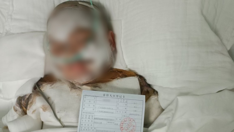 意外跌入滚烫豆浆桶，广东5岁男童全身80%烧伤！