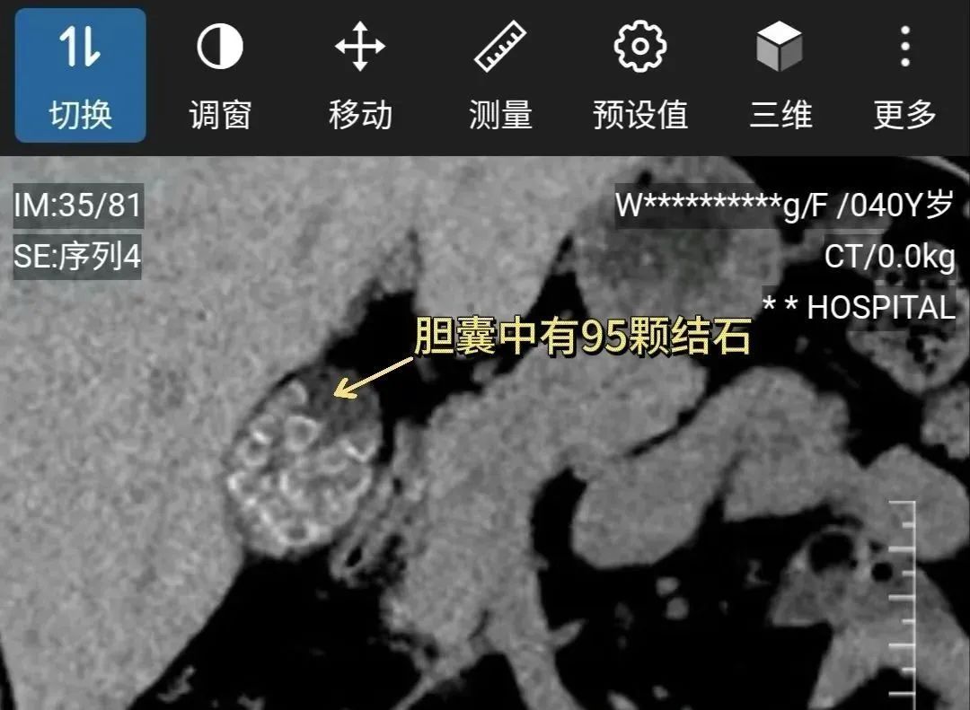 女子体内密密麻麻近百颗“石头”!医生震惊:太危险了! 这个习惯很多人都有 女子体内密密麻麻近百颗“石头”!医生震惊:太危险了! 这个习惯很多人都有