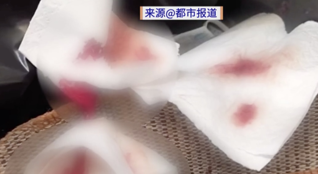 女子狂炫10斤荔枝!次日狂流鼻血进急诊,确诊“荔枝病” 女子狂炫10斤荔枝!次日狂流鼻血进急诊,确诊“荔枝病”