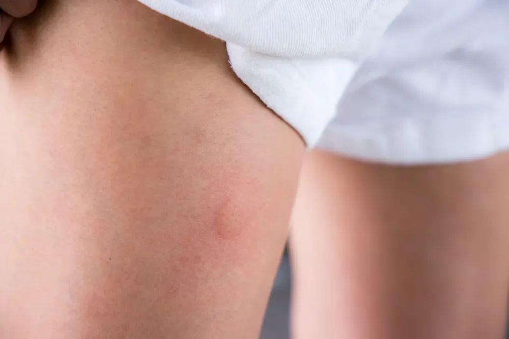 被蚊子咬了能迅速止痒的4个方法 希望大家都用不上 被蚊子咬了能迅速止痒的4个方法 希望大家都用不上