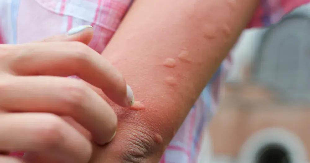 被蚊子咬了能迅速止痒的4个方法 希望大家都用不上 被蚊子咬了能迅速止痒的4个方法 希望大家都用不上