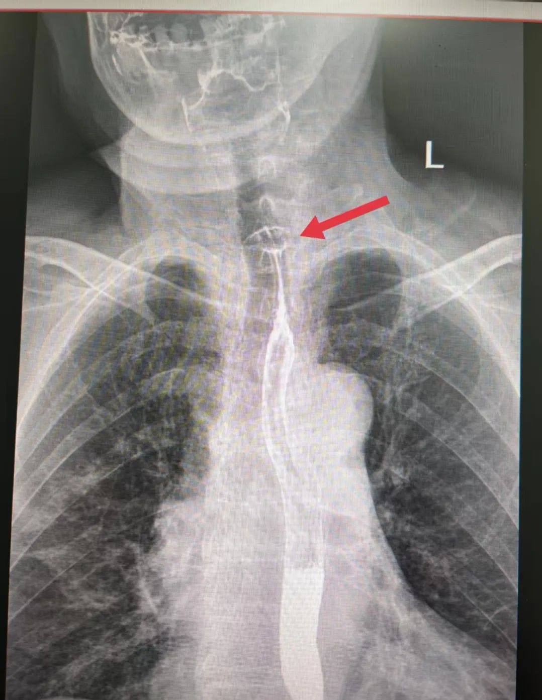 好吃却可能惹出大麻烦,警惕粽子里的“隐形刺客” 好吃却可能惹出大麻烦,警惕粽子里的“隐形刺客”
