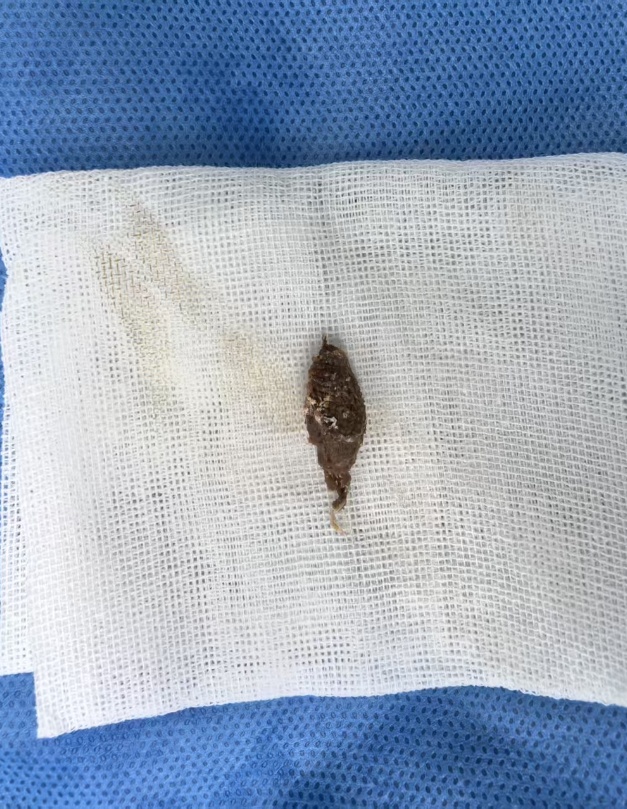 好吃却可能惹出大麻烦,警惕粽子里的“隐形刺客” 好吃却可能惹出大麻烦,警惕粽子里的“隐形刺客”