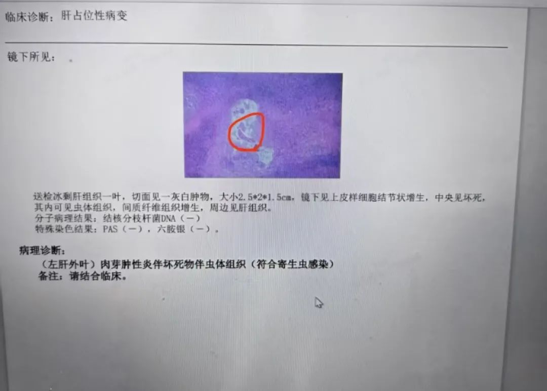 头皮发麻!台州男子左肝被掏空一大块!原因竟是…… 头皮发麻!台州男子左肝被掏空一大块!原因竟是……