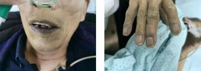 25岁小伙全身青紫,陷入深昏迷,尿液呈“诡异蓝色”!医生:剧毒,0.5克可致命 25岁小伙全身青紫,陷入深昏迷,尿液呈“诡异蓝色”!医生:剧毒,0.5克可致命