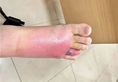 沙发上睡一觉被虫咬,差点截趾!严重或危及生命,千万当心! 沙发上睡一觉被虫咬,差点截趾!严重或危及生命,千万当心!