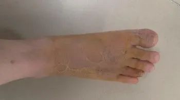 沙发上睡一觉被虫咬,差点截趾!严重或危及生命,千万当心! 沙发上睡一觉被虫咬,差点截趾!严重或危及生命,千万当心!