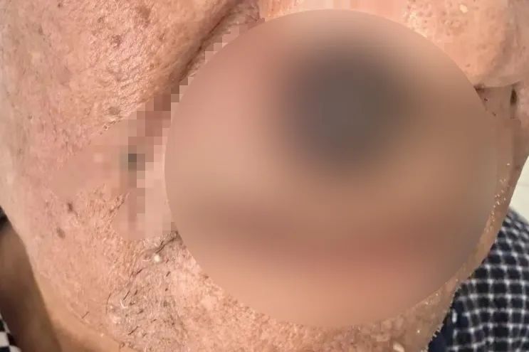 男子癌症晚期、全身恶臭……上海专家拒绝手术，但最后被他说动了