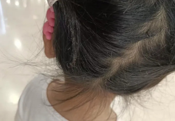 突然爆炸燃起巨大火光！女童汗毛和头发被烧焦，紧急提醒：危险别买