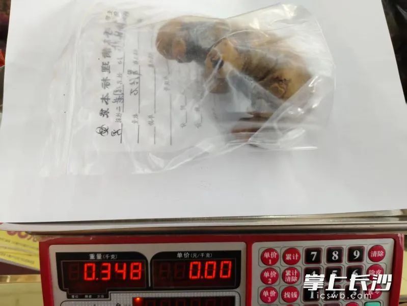 罕见!潜伏20年,男子肾脏长出巨大“姜块” 罕见!潜伏20年,男子肾脏长出巨大“姜块”