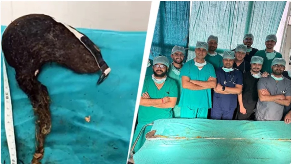 印度14岁少女腹中取出210厘米毛发结石,创世界纪录 印度14岁少女腹中取出210厘米毛发结石,创世界纪录