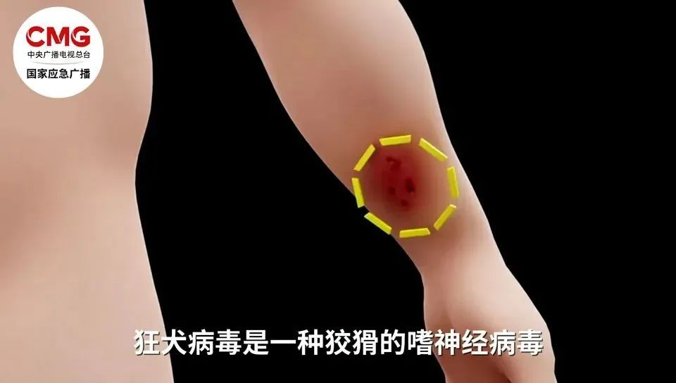 手背肌腱被咬断! 近期激增, 一天接诊200例! 一旦发病致死率几乎100% 手背肌腱被咬断! 近期激增, 一天接诊200例! 一旦发病致死率几乎100%