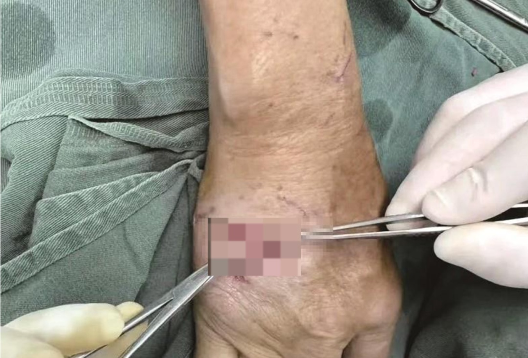 福建一女子手背肌腱被咬断!猫犬伤人近期激增,一旦发病致死率几乎100% 福建一女子手背肌腱被咬断!猫犬伤人近期激增,一旦发病致死率几乎100%