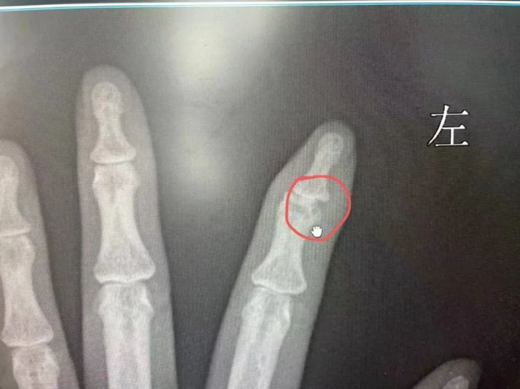 小伙脖子被扎多根烧烤签，上面还挂着肉！类似事件曾多次发生，医生提醒