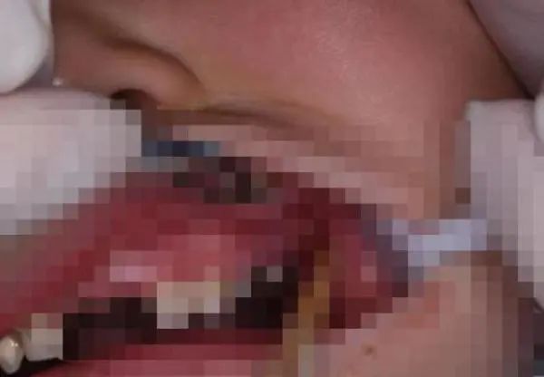 小伙脖子被扎多根,上面还挂着肉!很多人夏天都爱,当心成"凶器" 小伙脖子被扎多根,上面还挂着肉!很多人夏天都爱,当心成"凶器"