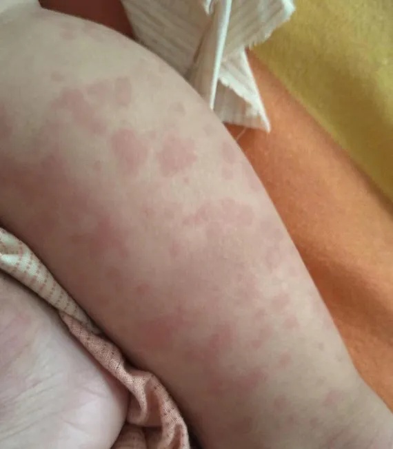 密密麻麻!浙江女孩长满疙瘩奇痒无比!近期高发,医生紧急提醒 密密麻麻!浙江女孩长满疙瘩奇痒无比!近期高发,医生紧急提醒