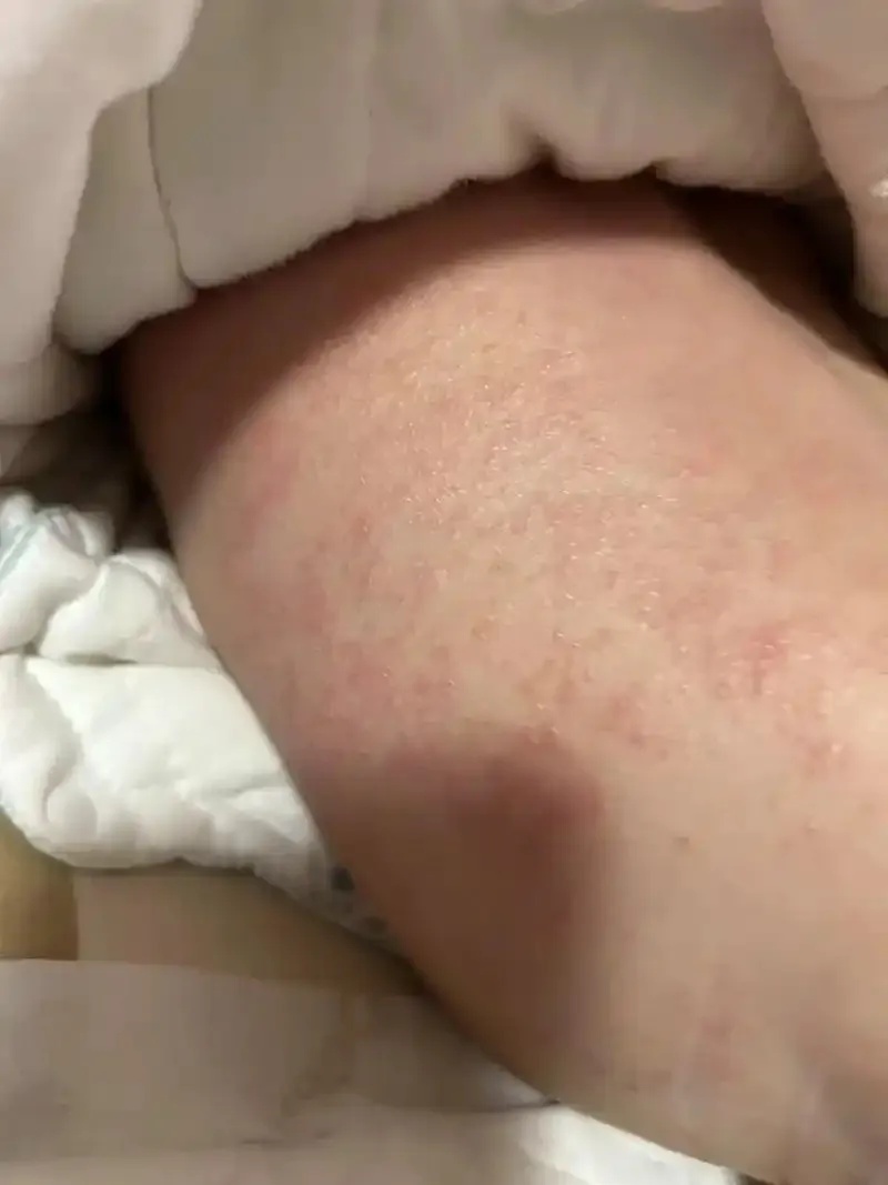 密密麻麻!浙江女孩长满疙瘩奇痒无比!近期高发,医生紧急提醒 密密麻麻!浙江女孩长满疙瘩奇痒无比!近期高发,医生紧急提醒