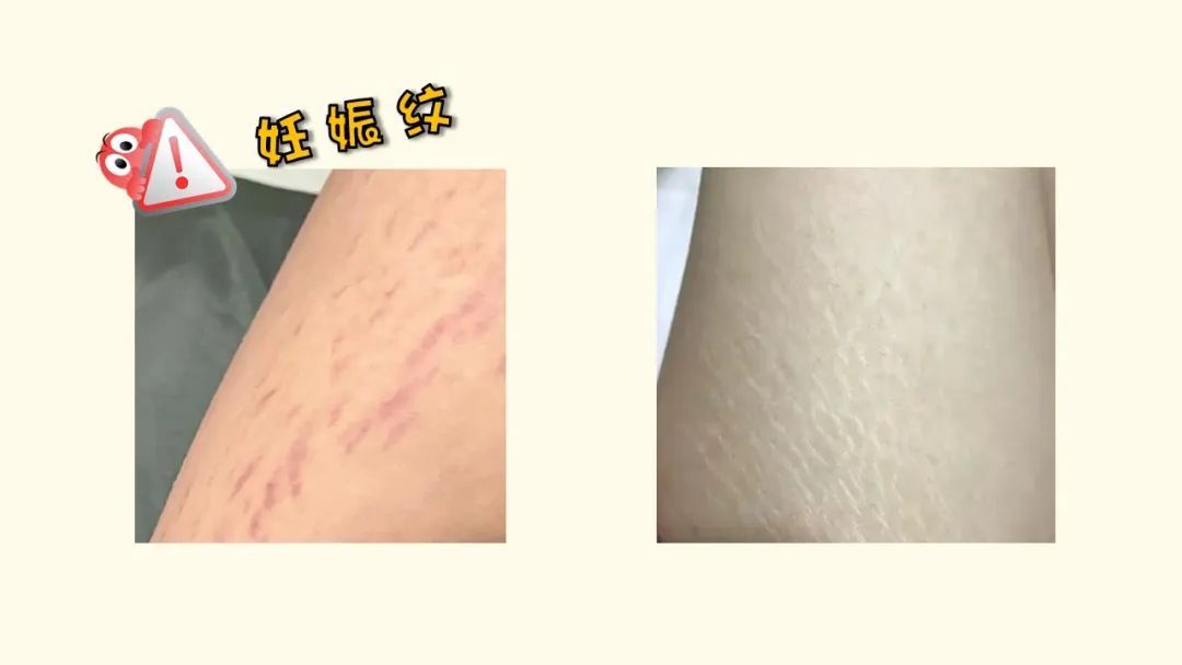 不用饿肚子!专家支招让娃轻松“掉秤”不反弹! 不用饿肚子!专家支招让娃轻松“掉秤”不反弹!