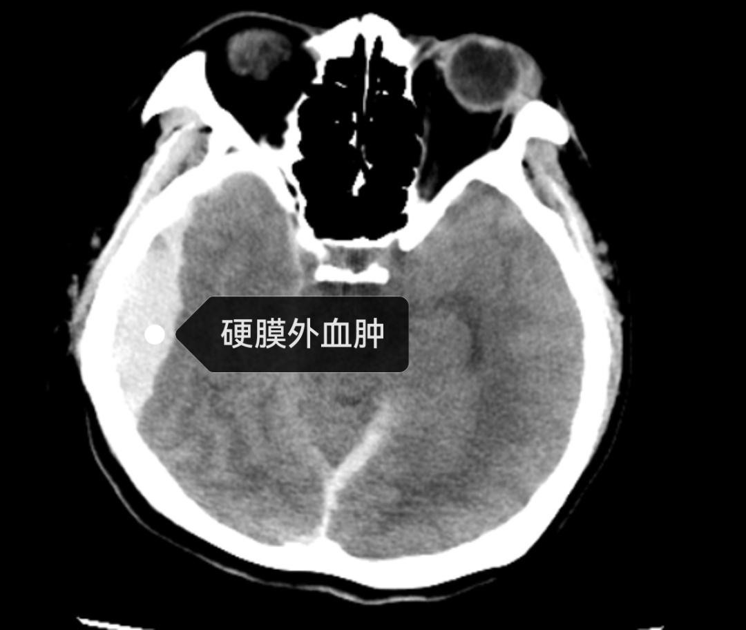 吃席后高热出血!近期活动频繁,警惕感染风险 吃席后高热出血!近期活动频繁,警惕感染风险