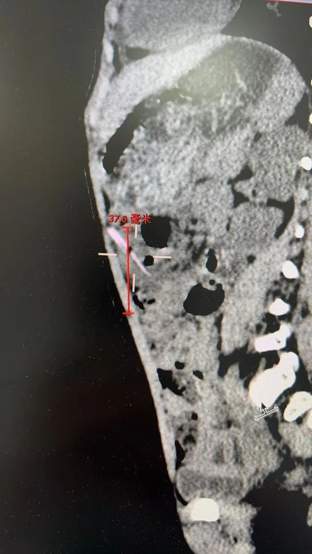 2岁女孩突然腹痛,家长以为是肠胃炎,去医院一看吓坏!警惕这些“无声杀手”…… 2岁女孩突然腹痛,家长以为是肠胃炎,去医院一看吓坏!警惕这些“无声杀手”……