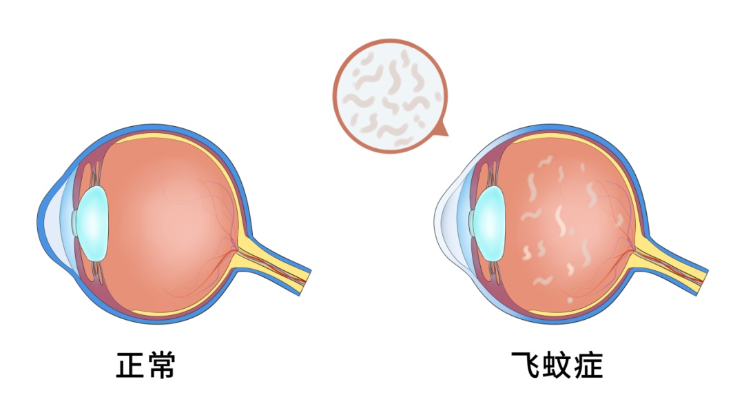 眼前“小飞虫”到底是什么?一文教你分清“生理性”还是“病理性” 眼前“小飞虫”到底是什么?一文教你分清“生理性”还是“病理性”