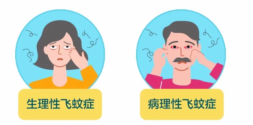 眼前“小飞虫”到底是什么?一文教你分清“生理性”还是“病理性” 眼前“小飞虫”到底是什么?一文教你分清“生理性”还是“病理性”