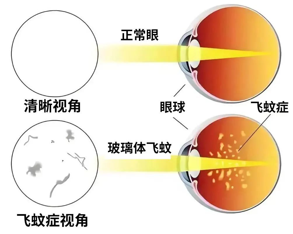 眼前“小飞虫”到底是什么?一文教你分清“生理性”还是“病理性” 眼前“小飞虫”到底是什么?一文教你分清“生理性”还是“病理性”