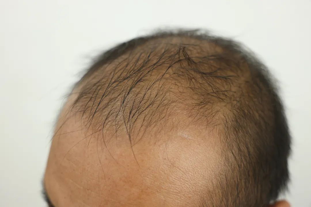 “没案子办，秃点也行！”