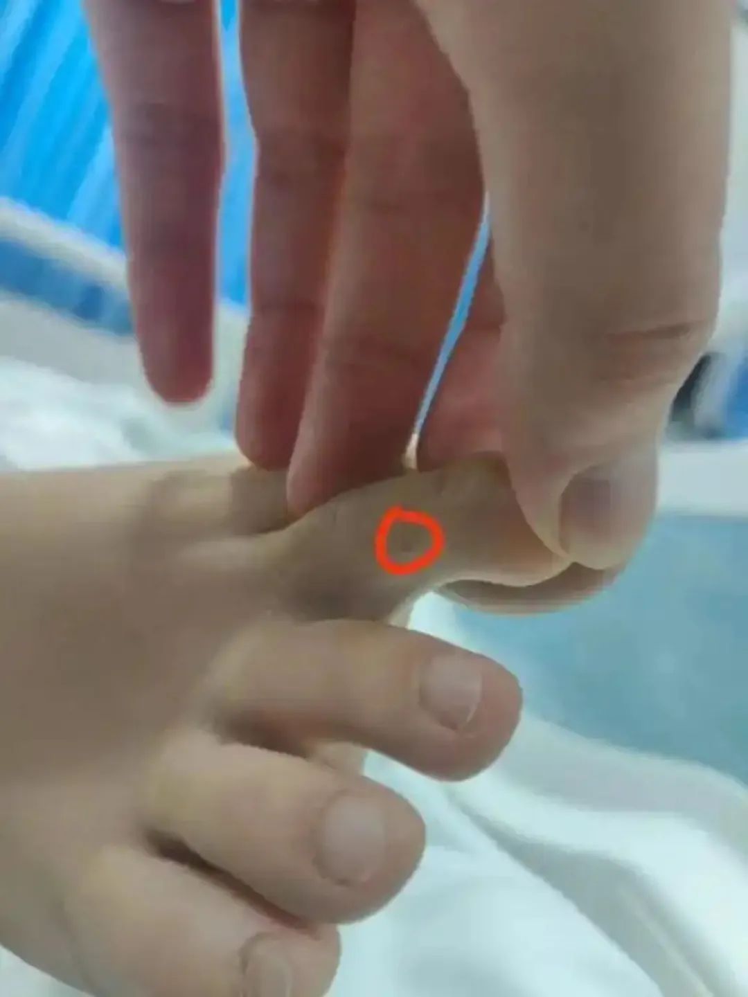 女子疑被蛇咬伤身亡！河南急诊科医生：近期接诊过2例，被毒蛇咬伤要这样急救→