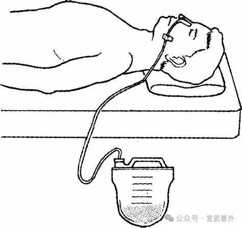 小肠减压管:为肠道“减负”的神器 小肠减压管:为肠道“减负”的神器