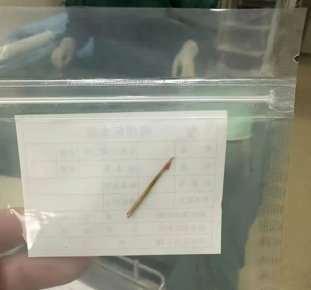 警惕！2岁女孩腹腔内有一根尖锐竹签！不少孩子都有这个习惯