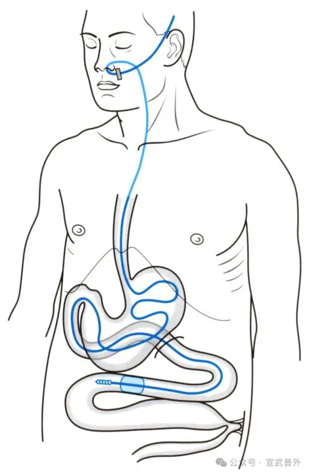 小肠减压管:为肠道“减负”的神器 小肠减压管:为肠道“减负”的神器