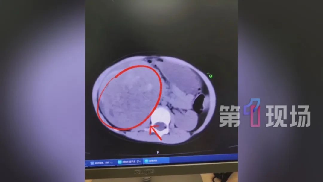 5岁女童玩耍被踩,致肾脏破裂……医生提醒→ 5岁女童玩耍被踩,致肾脏破裂……医生提醒→