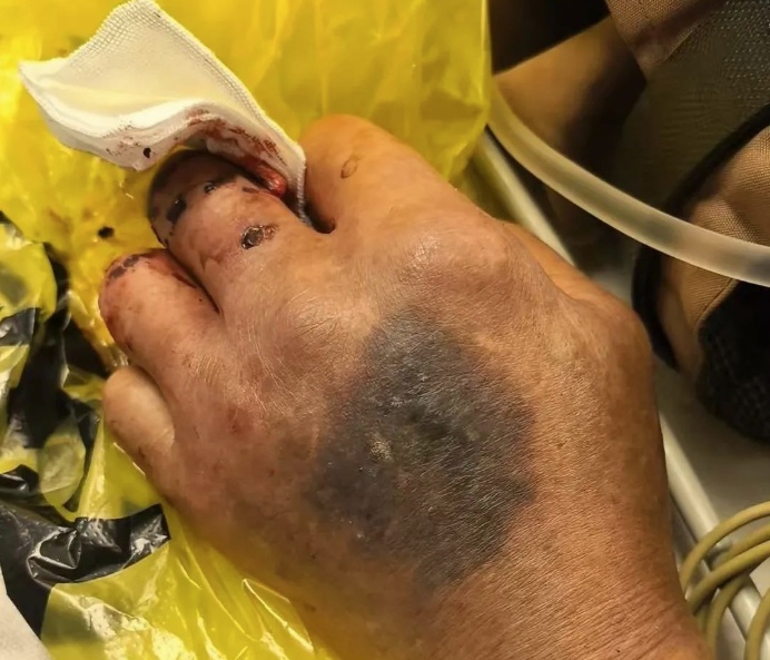 男子遭不明毒蛇咬伤,心跳骤停!然而抢救陷入僵局…… 男子遭不明毒蛇咬伤,心跳骤停!然而抢救陷入僵局……