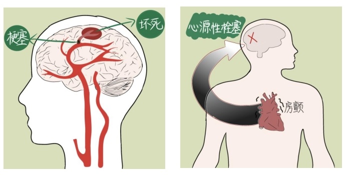 她脑梗去世！一周前还在割麦子，昏迷三天三夜未能救回！紧急提醒…