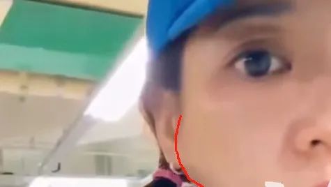 42岁陈意涵医美后脸歪了，称AI让其“一天热敷23次且每次1015分钟”
