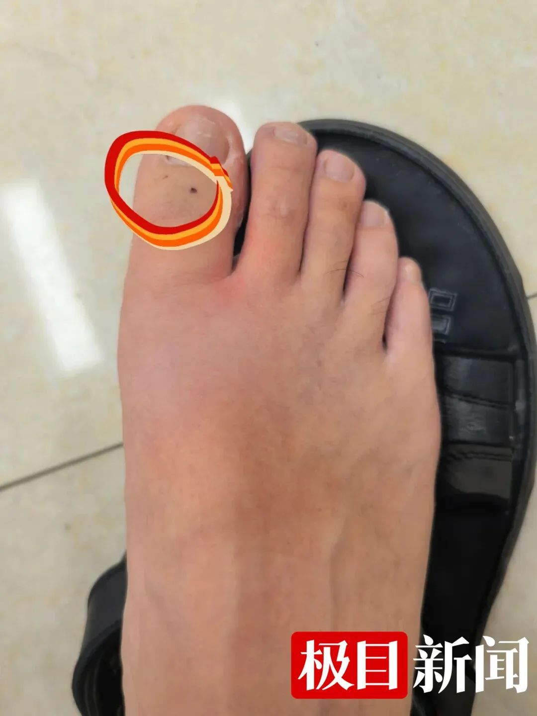 男子湖边散步脚被咬伤！近期高发