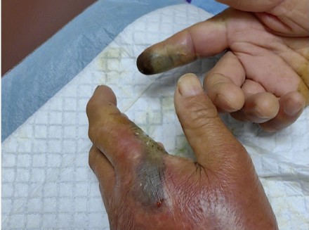 大爷钓鱼被毒蛇咬伤 去抓蛇再被咬 大爷钓鱼被毒蛇咬伤 去抓蛇再被咬