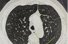 男子咳嗽数月以为小毛病,一查竟惹上“致命杀手” 男子咳嗽数月以为小毛病,一查竟惹上“致命杀手”