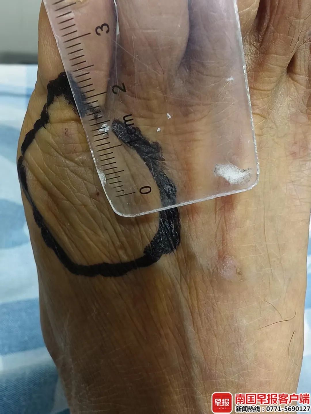 广西一男子被毒蛇咬伤,注射血清后仍陷入昏迷!再次注射后…… 广西一男子被毒蛇咬伤,注射血清后仍陷入昏迷!再次注射后……