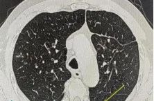 男子咳嗽数月以为小毛病,一查竟惹上“致命杀手”! 男子咳嗽数月以为小毛病,一查竟惹上“致命杀手”!