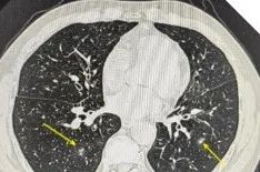 男子咳嗽数月以为小毛病,一查竟惹上“致命杀手”! 男子咳嗽数月以为小毛病,一查竟惹上“致命杀手”!