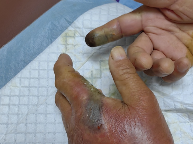 男子被蛇咬，忍痛去抓，又被咬一口！紧急提醒：这些保命细节必须知道