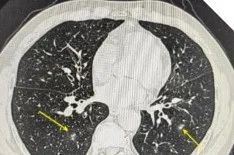 男子咳嗽数月以为小毛病,一查竟惹上“致命杀手” 男子咳嗽数月以为小毛病,一查竟惹上“致命杀手”